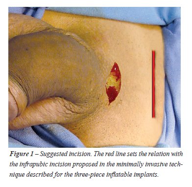 tendon în penis