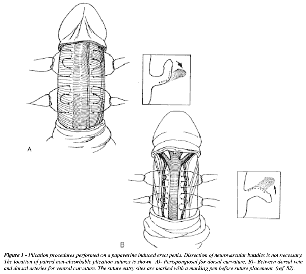 Stitch Granuloma
