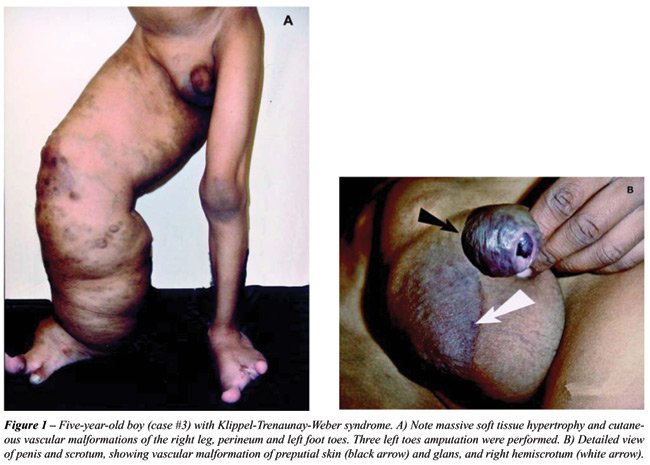 pelvic mass.